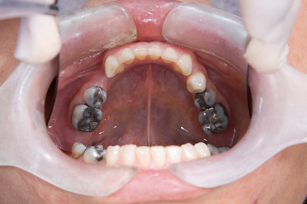 Metallentfernung Hamburg - das Bild zeigt einen Patientenmund. Hierbei sieht man das Amalgam auf den hinteren Zähnen