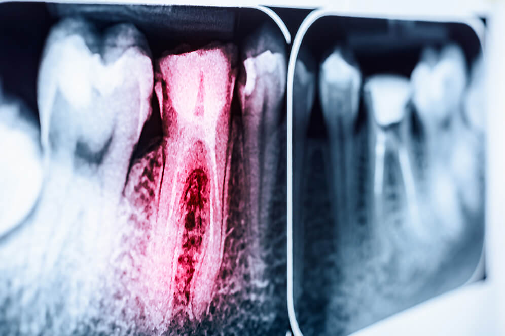 Wurzelkanalbehandlung Hamburg - ein Röntgenbild eines wurzelbehandelten Zahnes